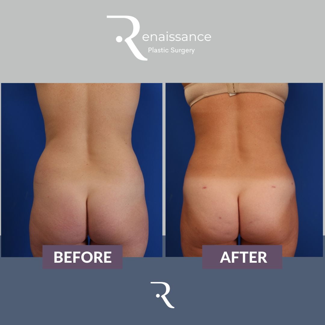 Liposuction In Austin